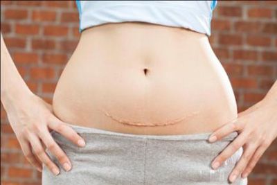 Sẹo mổ lấy thai là gì? Dấu hiệu và những điều mẹ cần biết